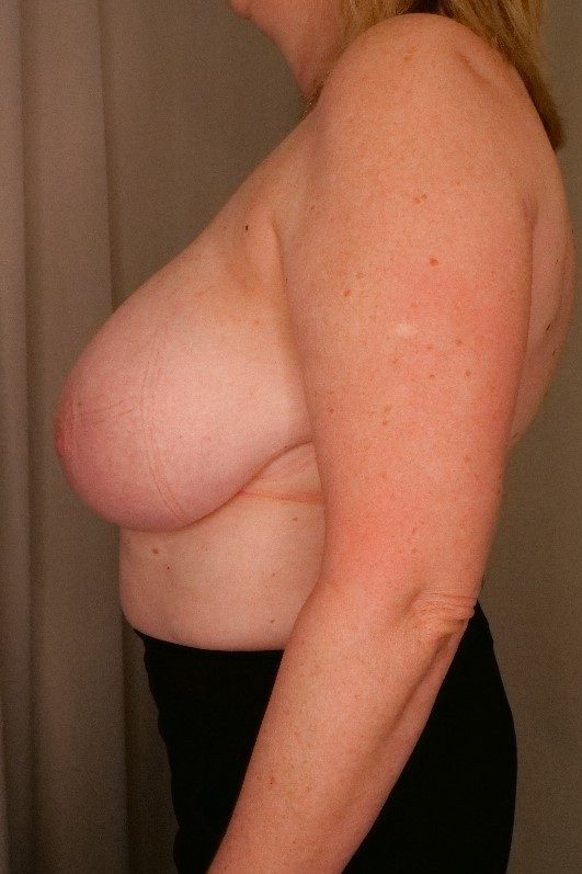 Breast Reduction