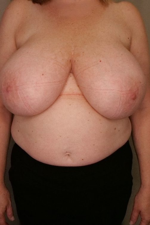 Breast Reduction