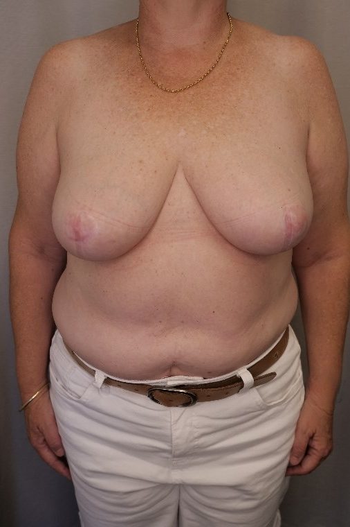 Breast Reduction