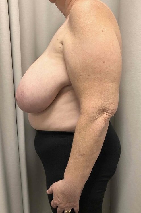 Breast Reduction