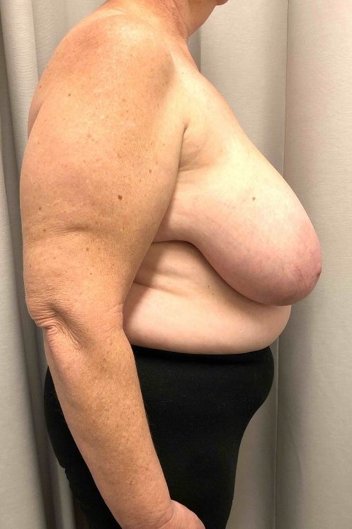 Breast Reduction