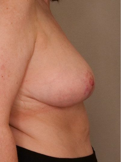 Breast Reduction