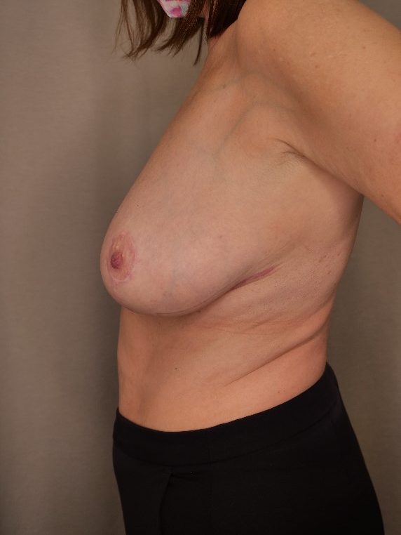 Breast Reduction
