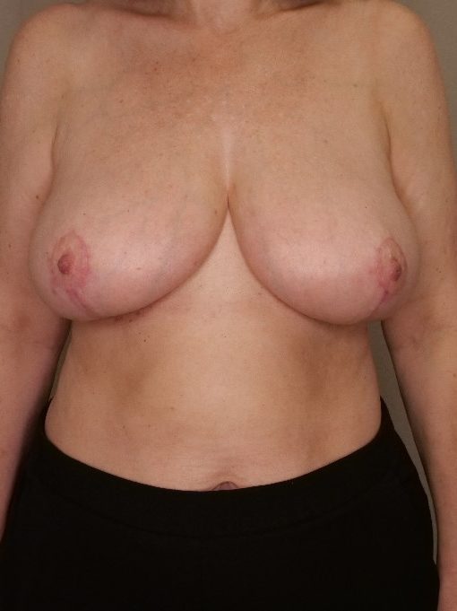 Breast Reduction