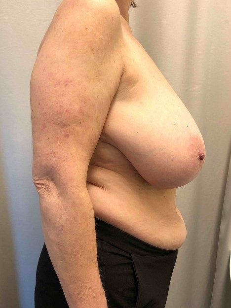 Breast Reduction