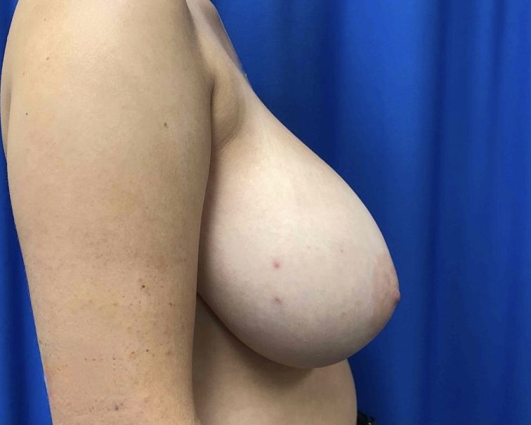 Breast Reduction