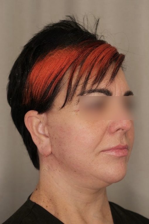 Facelift & Upper Blepharoplasty