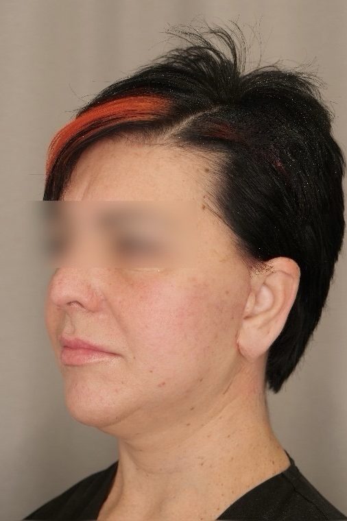Facelift & Upper Blepharoplasty