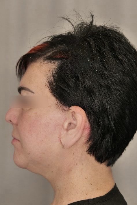 Facelift & Upper Blepharoplasty