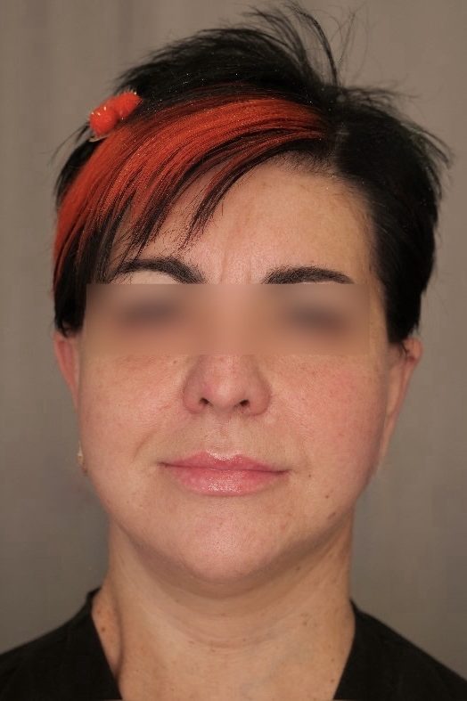 Facelift & Upper Blepharoplasty