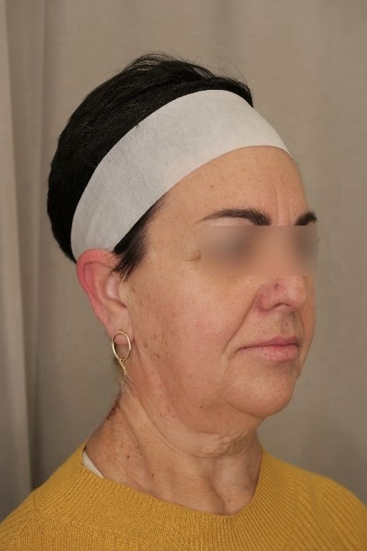 Facelift & Upper Blepharoplasty