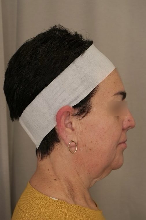 Facelift & Upper Blepharoplasty