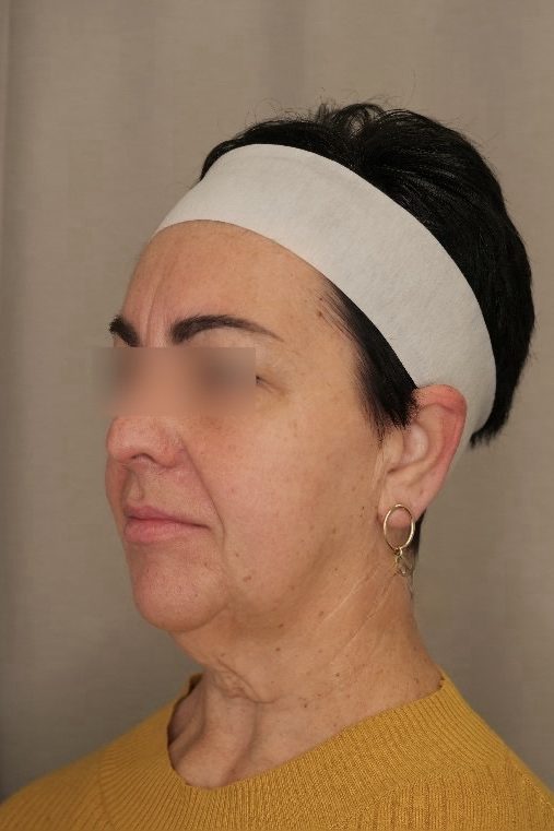 Facelift & Upper Blepharoplasty