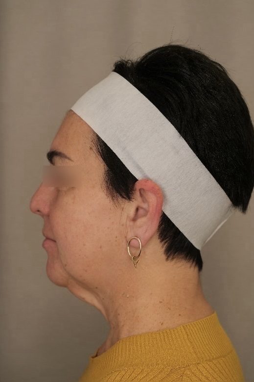 Facelift & Upper Blepharoplasty