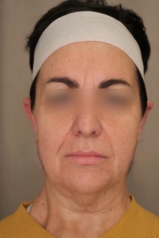 Facelift & Upper Blepharoplasty