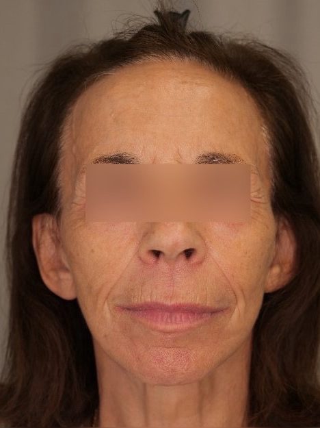 Facelift & Blepharoplasty