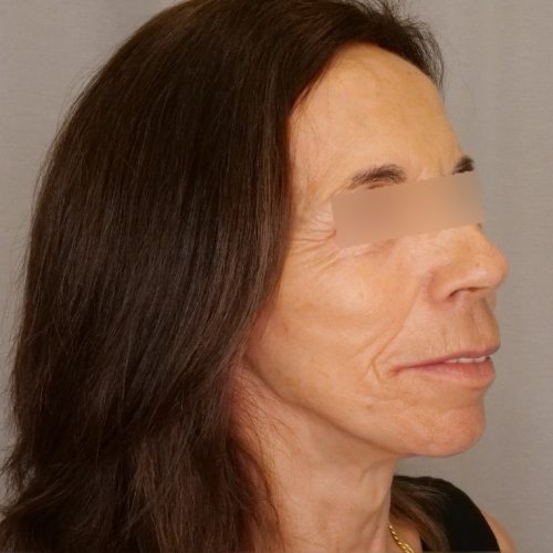 Facelift & Blepharoplasty