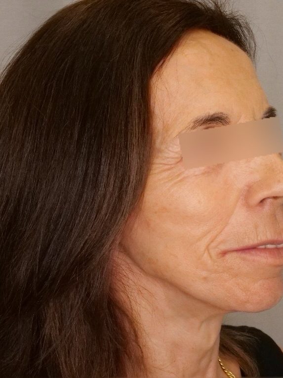 Facelift & Blepharoplasty