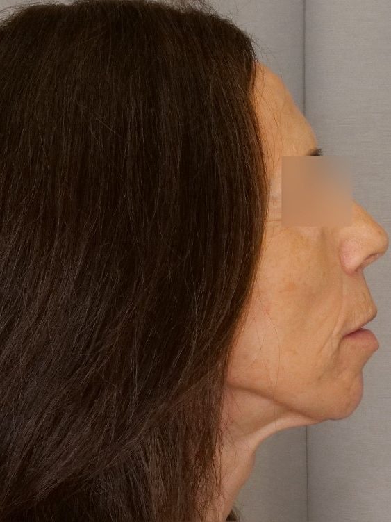 Facelift & Blepharoplasty