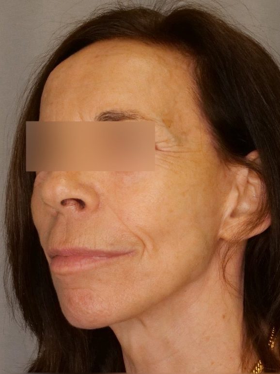 Facelift & Blepharoplasty