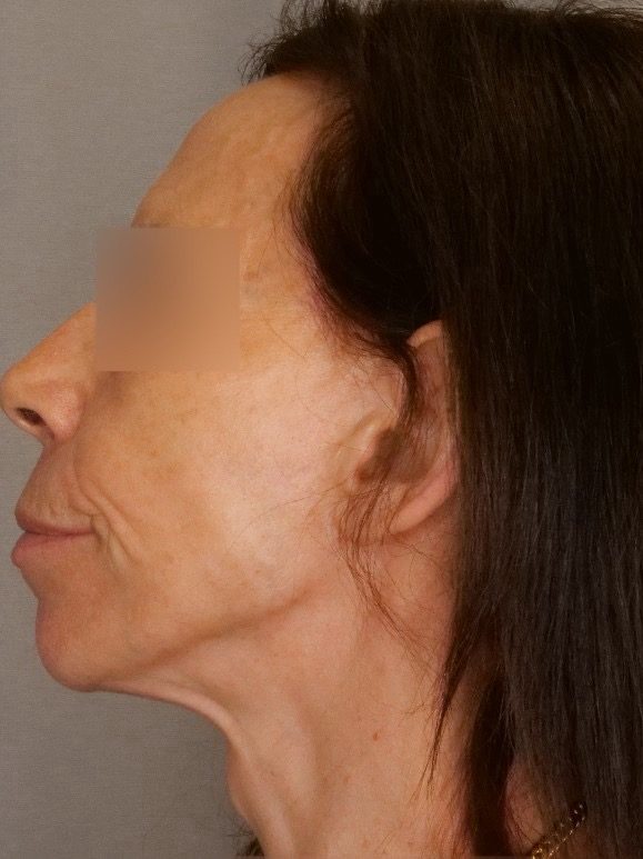 Facelift & Blepharoplasty