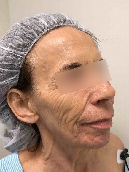Facelift & Blepharoplasty