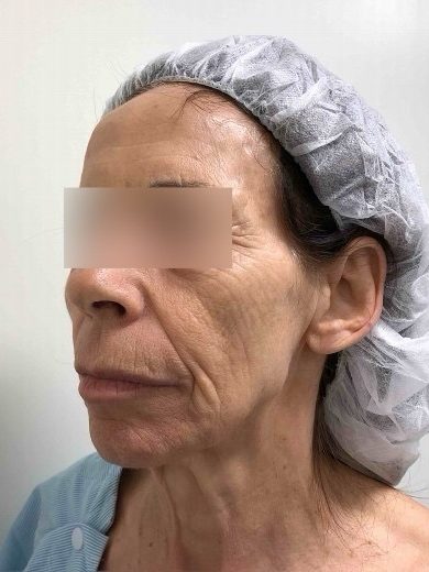 Facelift & Blepharoplasty