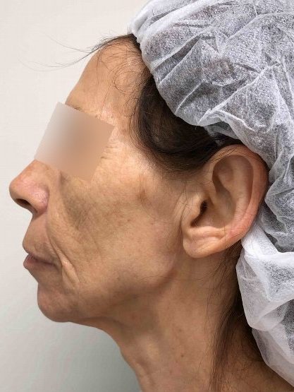Facelift & Blepharoplasty