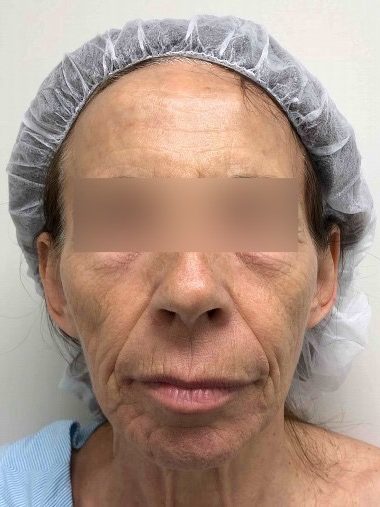 Facelift & Blepharoplasty