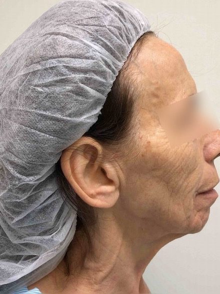 Facelift & Blepharoplasty