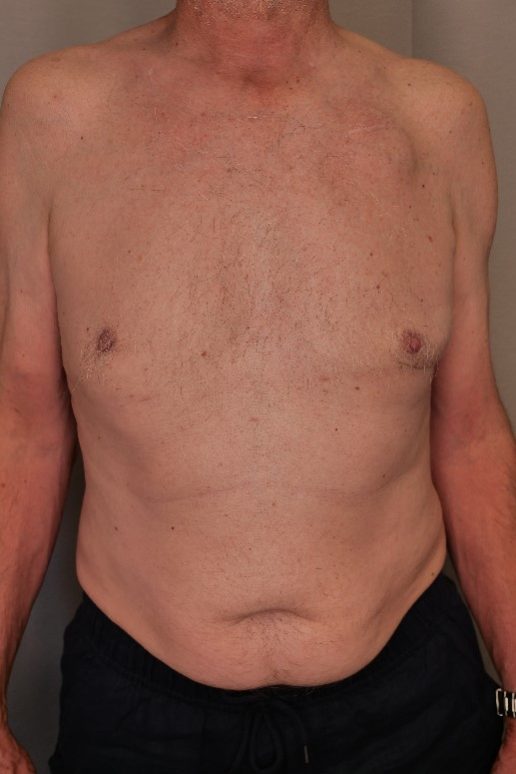 Gynaecomastia