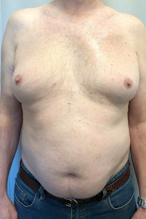 Gynaecomastia