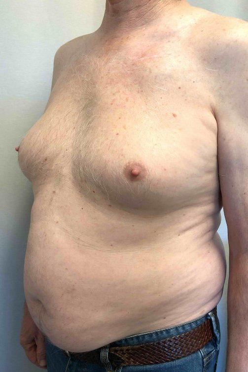 Gynaecomastia