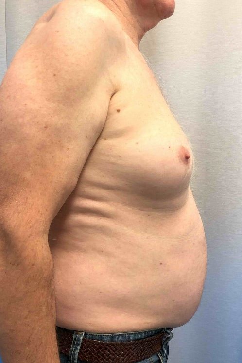 Gynaecomastia